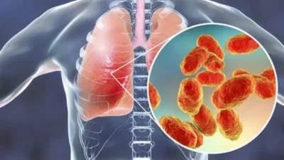 A picture of lungs highlighting where the pneumonia symptoms are