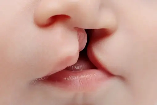 look at how a cleft lip to see how it is diagnosed