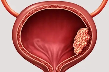 signs of bladder cancer