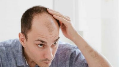 Everything You Need to Know About The New Hair Loss Treatment PP405