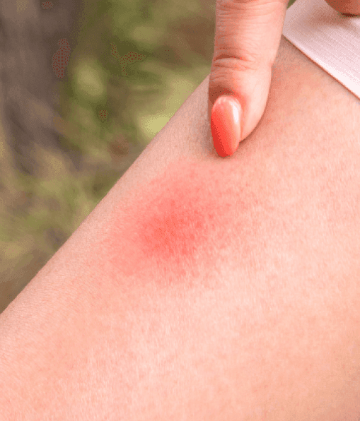 Infected Insect Bites