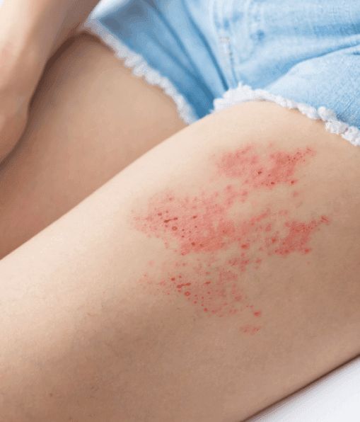 Shingles
