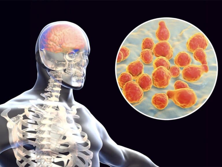 Meningitis symptoms