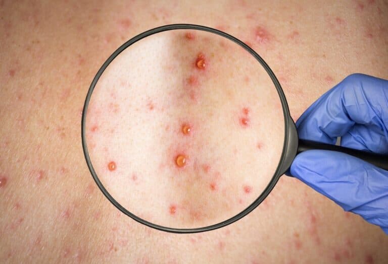 Shingles