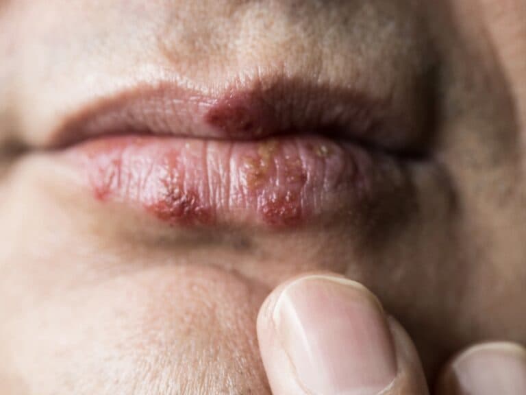 Herpes