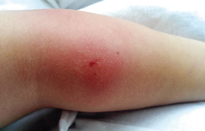 Infected Insect Bites