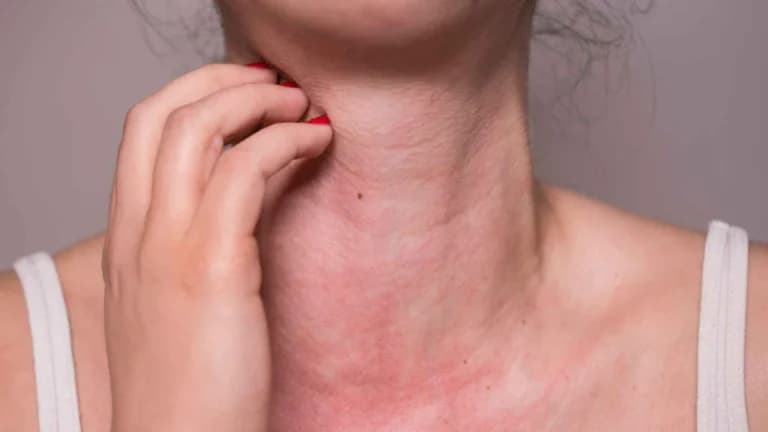 A person scratching their irritated and red neck, likely from allergies or hives, with their left hand, which has red nail polish, wearing a white tank top.