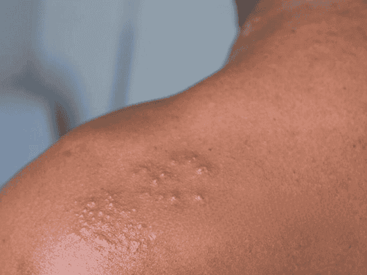 Close-up of a person's neck showing a patch of raised skin lesions resembling shingles.
