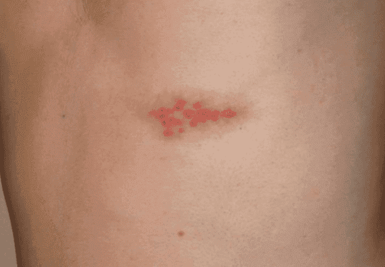 Close-up of a skin rash with red spots resembling shingles on human skin.