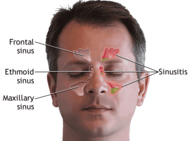 Sinusitis