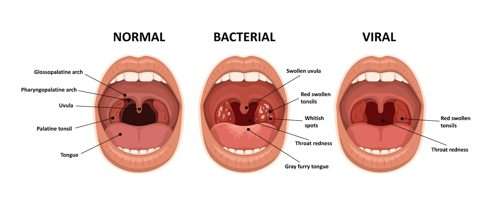 Sore Throat