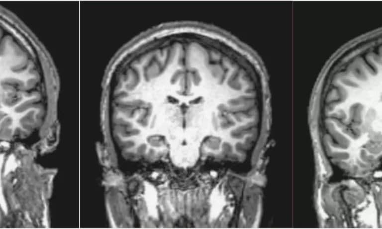 MRI scan of a brain, illustrating structural abnormalities often associated with schizophrenia, a mental health disorder that affects perception of reality