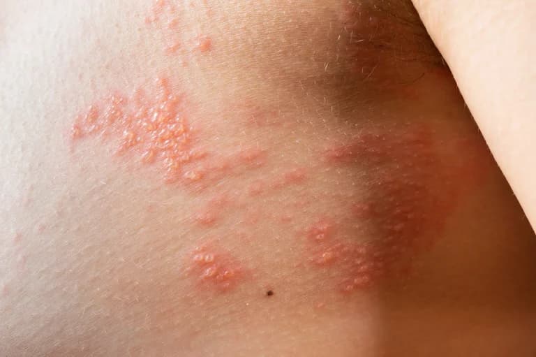 What is Shingles?