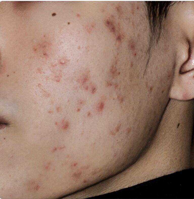 Acne