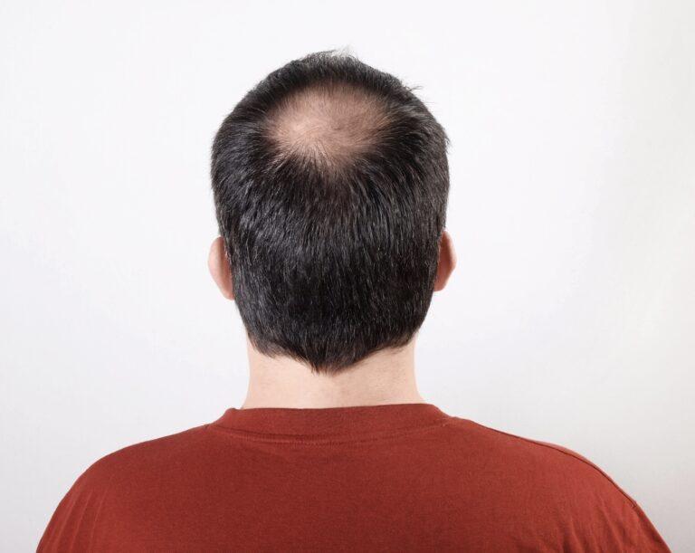 Mens baldness