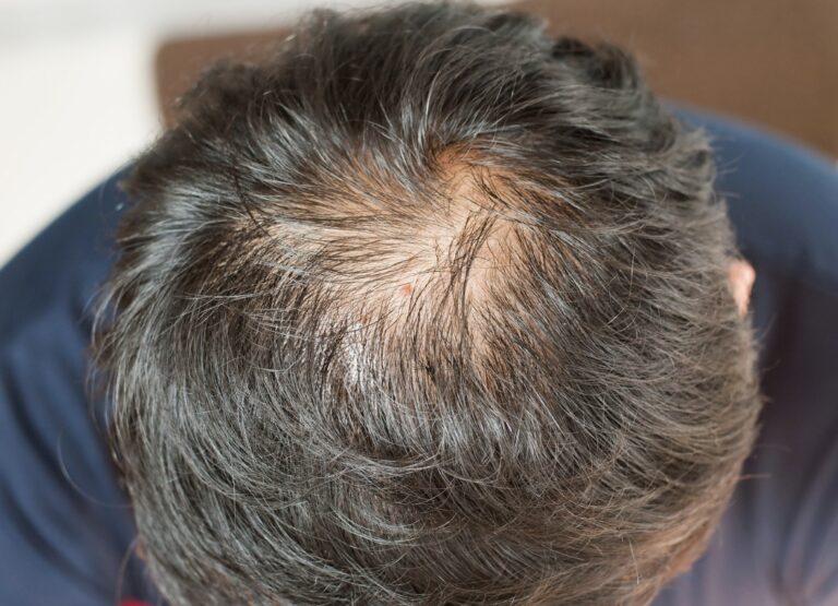 Mens hair loss