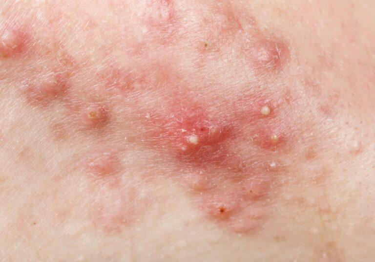 Cystic Acne
