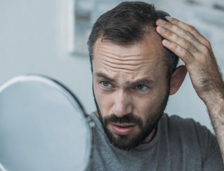 male pattern baldness