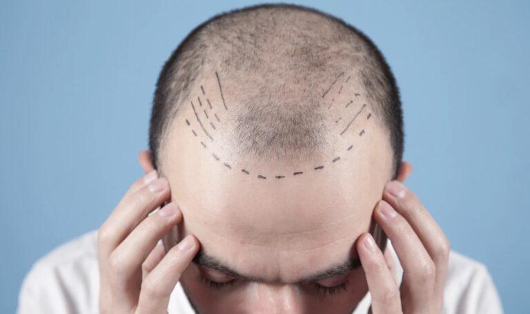 Mens hairline