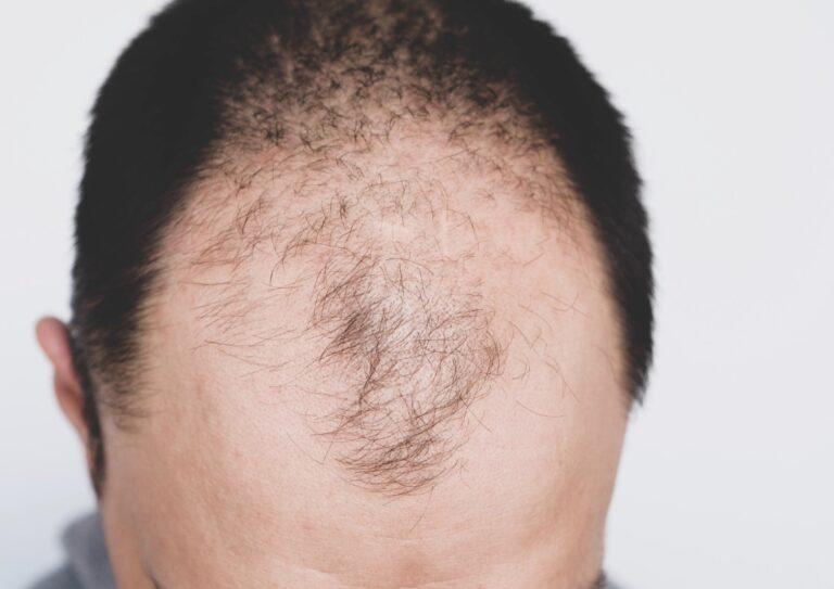 MALE PATTERN BALDNESS