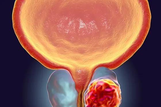 An illustration of a human urinary tract emphasizing the importance of understanding prostate cancer.