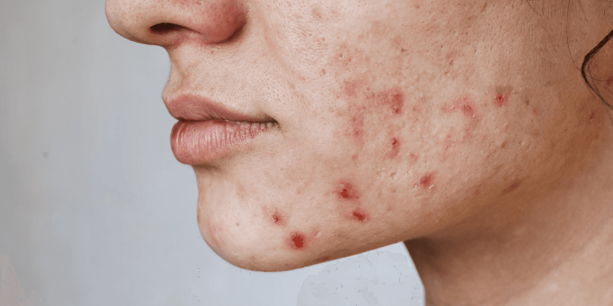 Acne