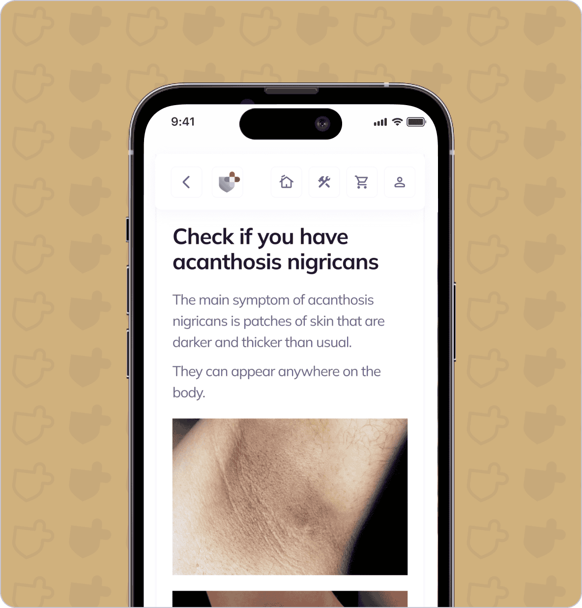 Smartphone screen displaying a webpage about acanthosis nigricans, highlighting its main symptom: dark, thick patches of skin, with an image of an affected skin area.