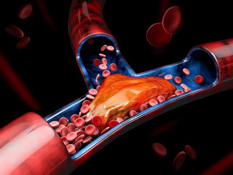 What is Embolism?