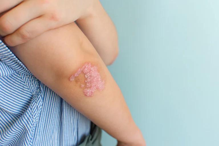 What is Psoriasis?