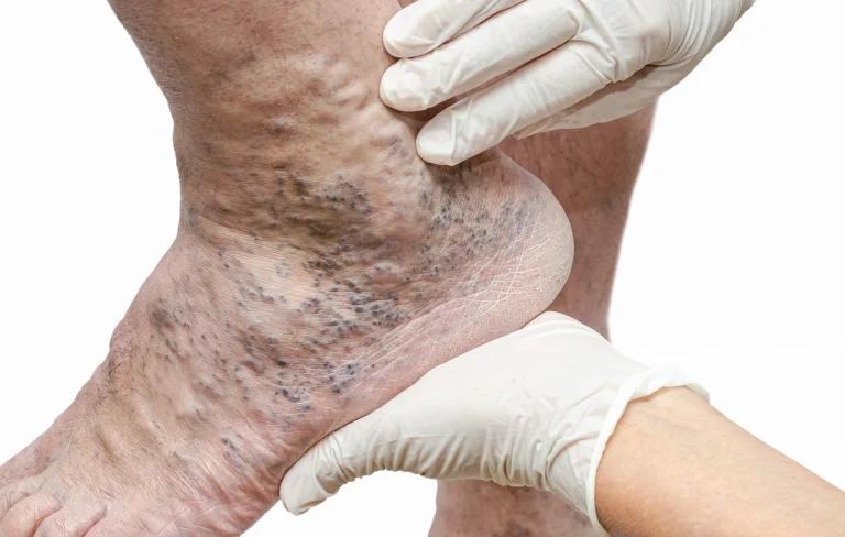 What is Deep Vein Thrombosis?