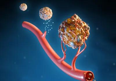 Cancer cells spreading taking a look if its related to bone marrow disease