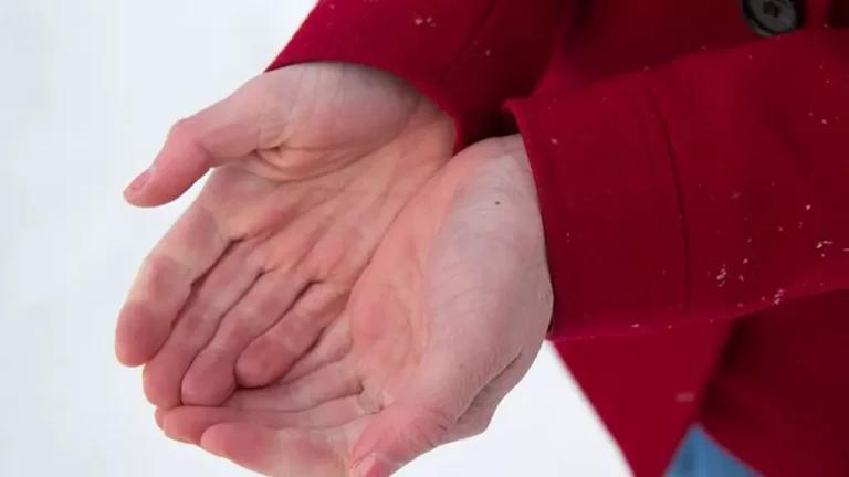 How to treat frostbite