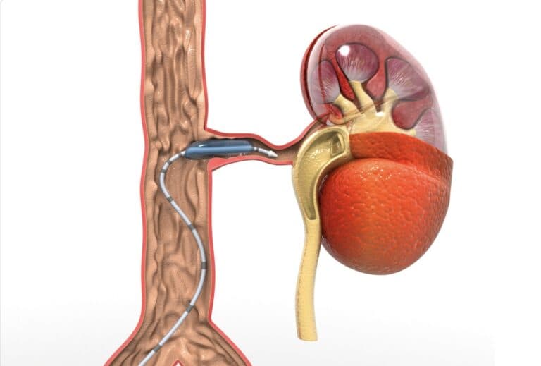 Peripheral Arterial disease