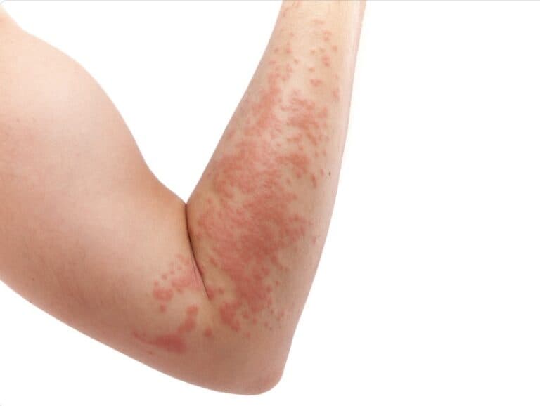 Penicillin allergy