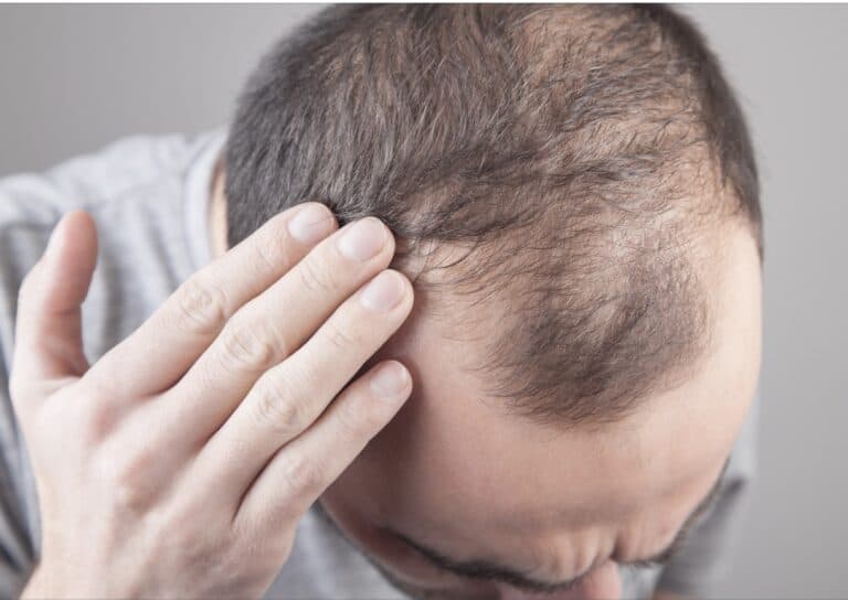 Hair loss