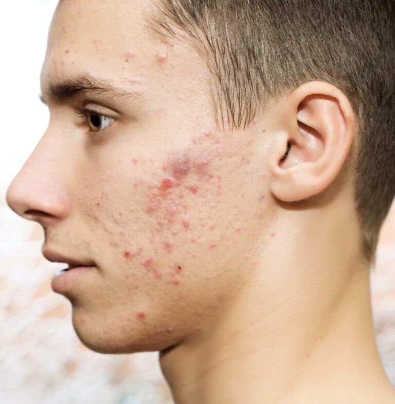 acne on face