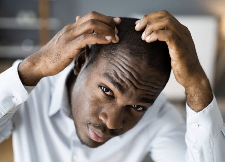 hair loss