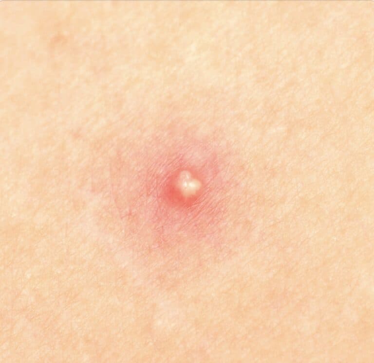 Pimple