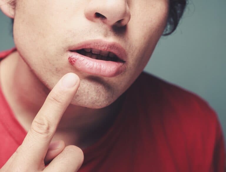 Cold sore