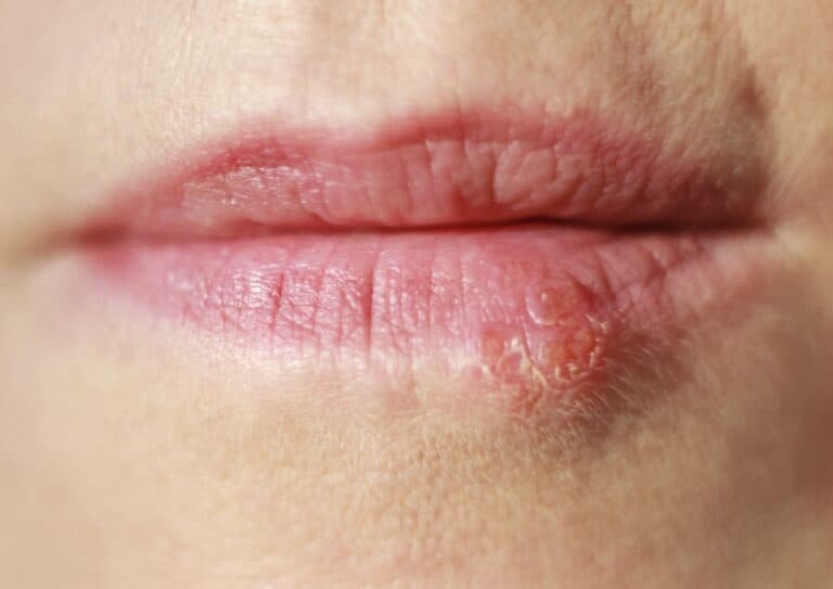 Lip cold sore