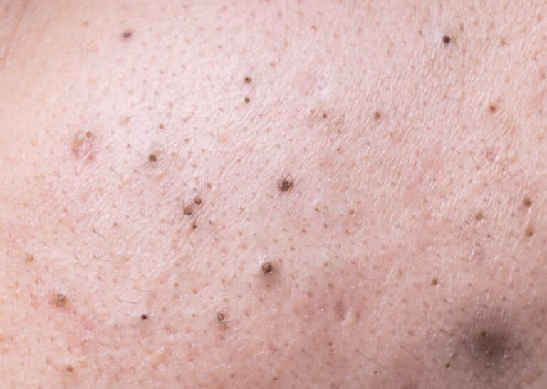 Blackheads