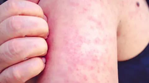 This arm has a red rash, possibly from measles.