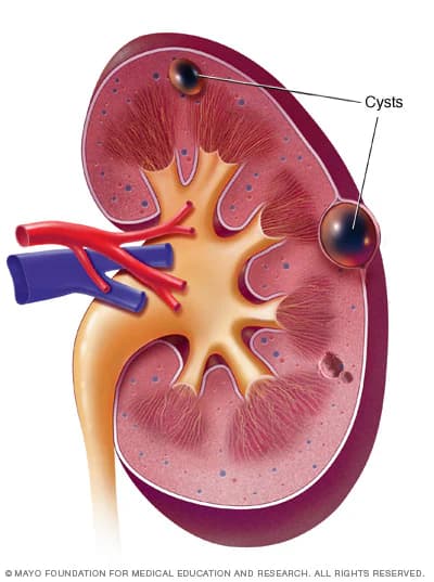 A diagram of a kidney with a blood vessel in the renal system.