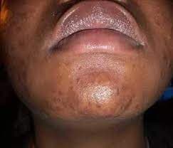 HIV signs