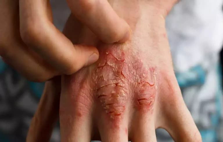 Hiv rash
