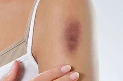 Close-up of a hematoma on an upper arm with a person's hand gently touching the area.