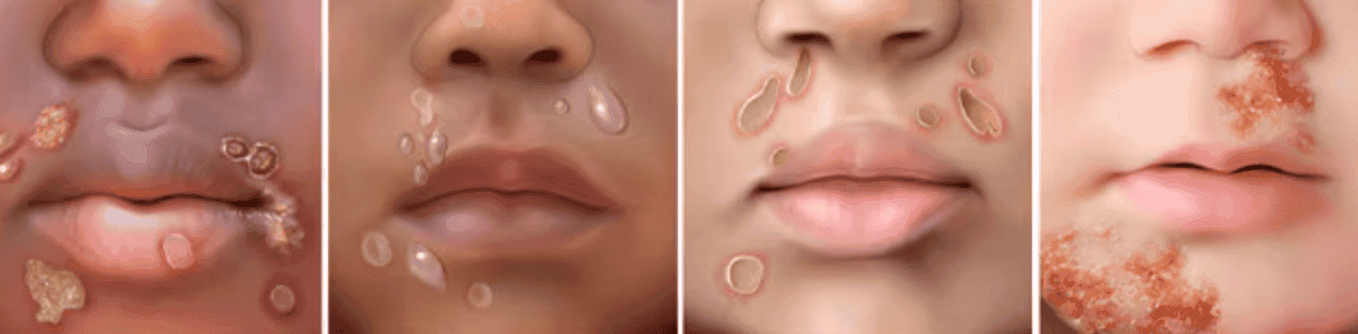Impetigo