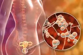 Illustration of a female body with a magnified view of fungal cells in the vaginal area, indicating a vaginal yeast infection, which can be caused by factors such as birth control.