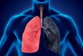 Illustration of a human torso showing two lungs, one healthy in red and one diseased and dark. The trachea and bronchi are also visible, highlighting the importance of asbestosis diagnosis.