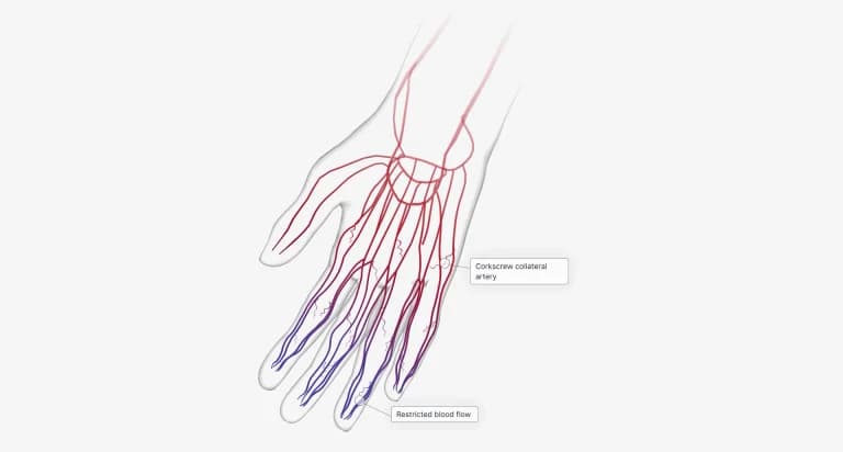 What is Peripheral Arterial Disease?